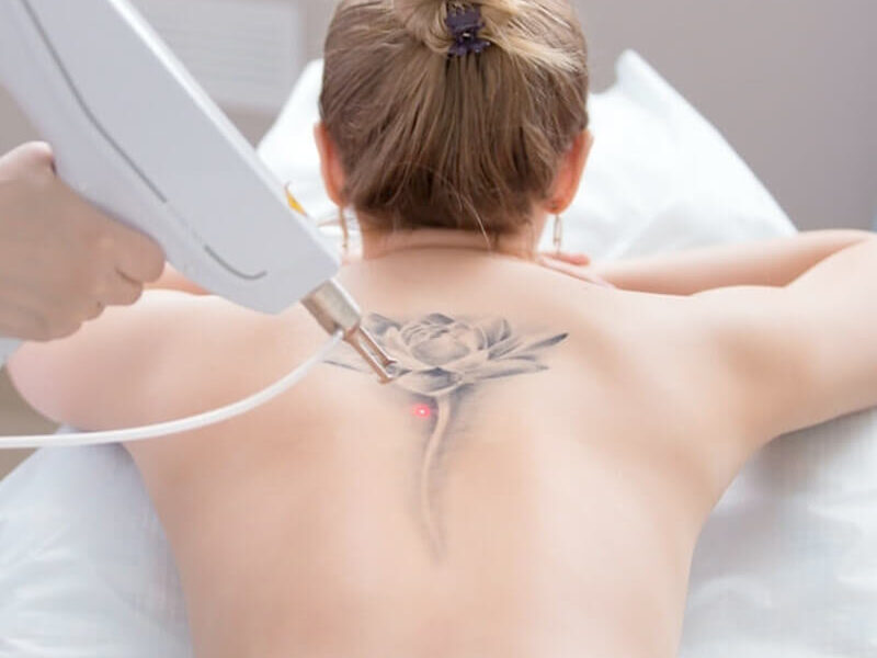 Eliminar tatuajes con láser en Madrid