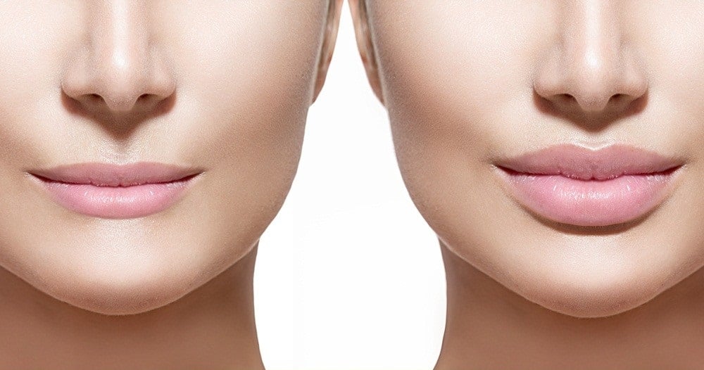 Labios acido hialuronico antes y después