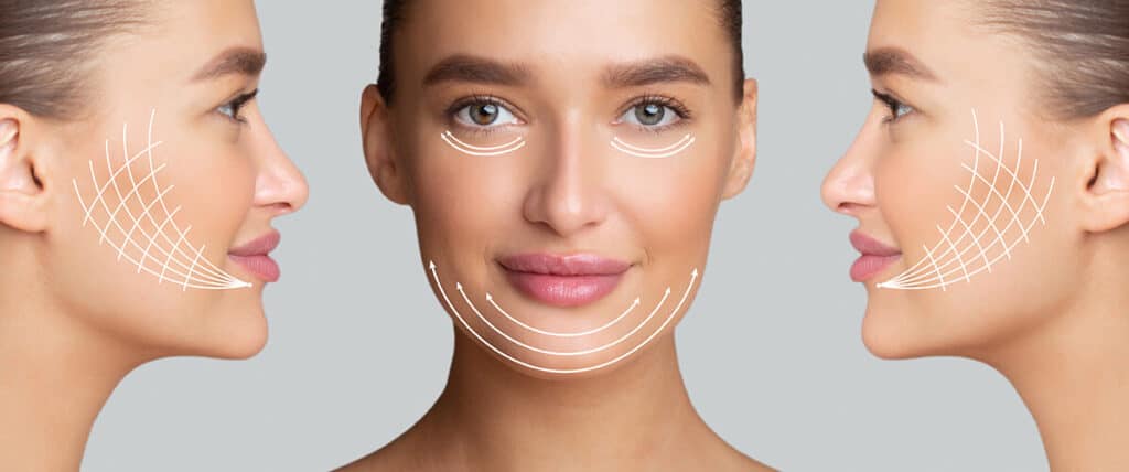 lifting facial estetica