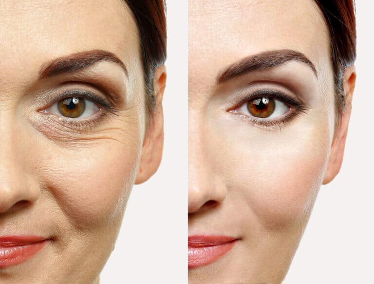 mesoterapia facial antes y despues