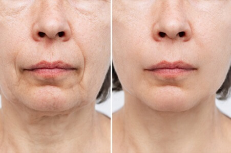 tratamiento prp facial antes y despues